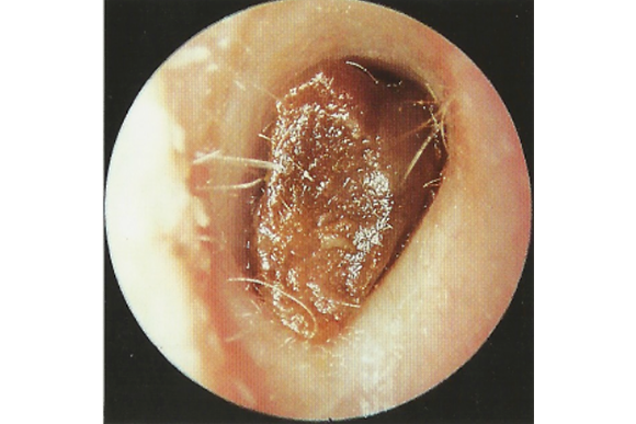 耳垢栓塞