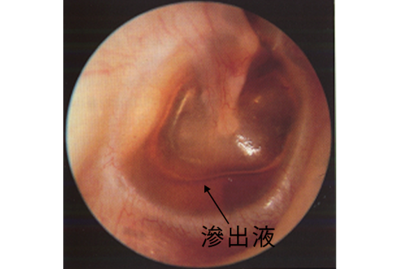 滲出性中耳炎
