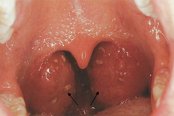 急性咽頭炎／急性扁桃炎／扁桃周囲膿瘍