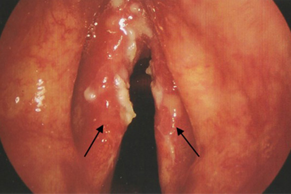 喉頭癌／咽頭癌
